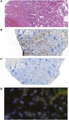 Transcriptomics-Guided Personalized Prescription of Targeted Therapeutics for Metastatic ALK-Positive Lung Cancer Case Following Recurrence on ALK Inhibitors